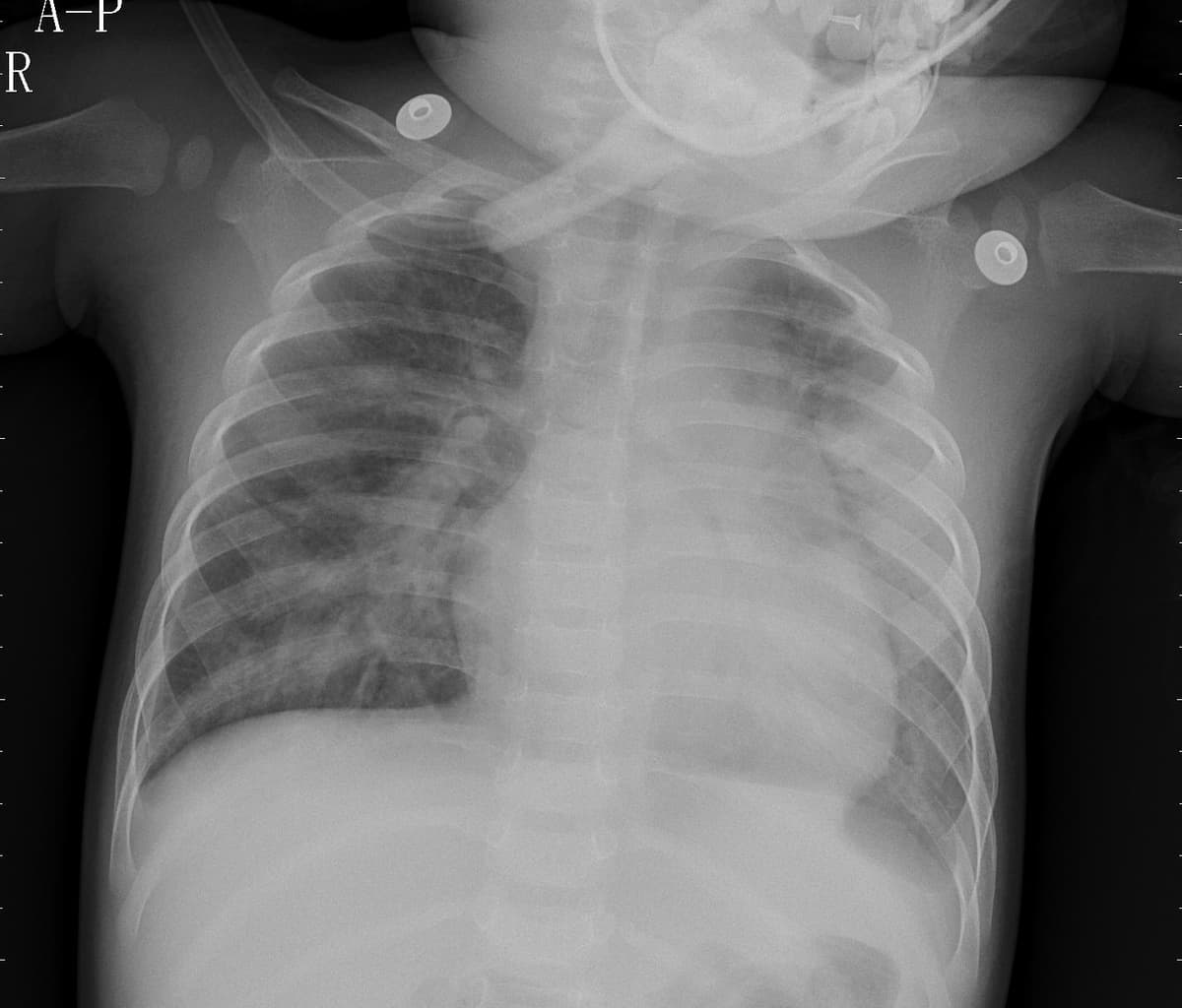 Pneumonia — NIH Chest X-ray14