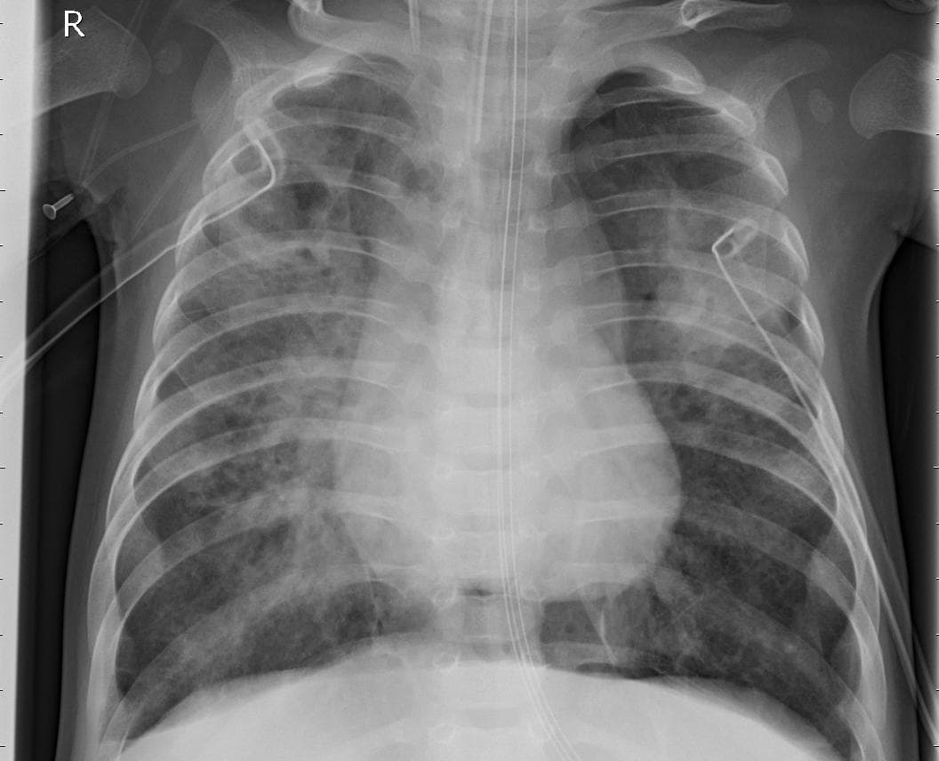 Pneumonia — NIH Chest X-ray14