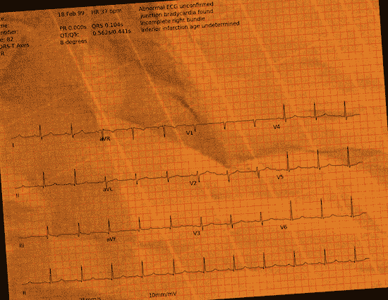 Normal ECG — PTB-XL