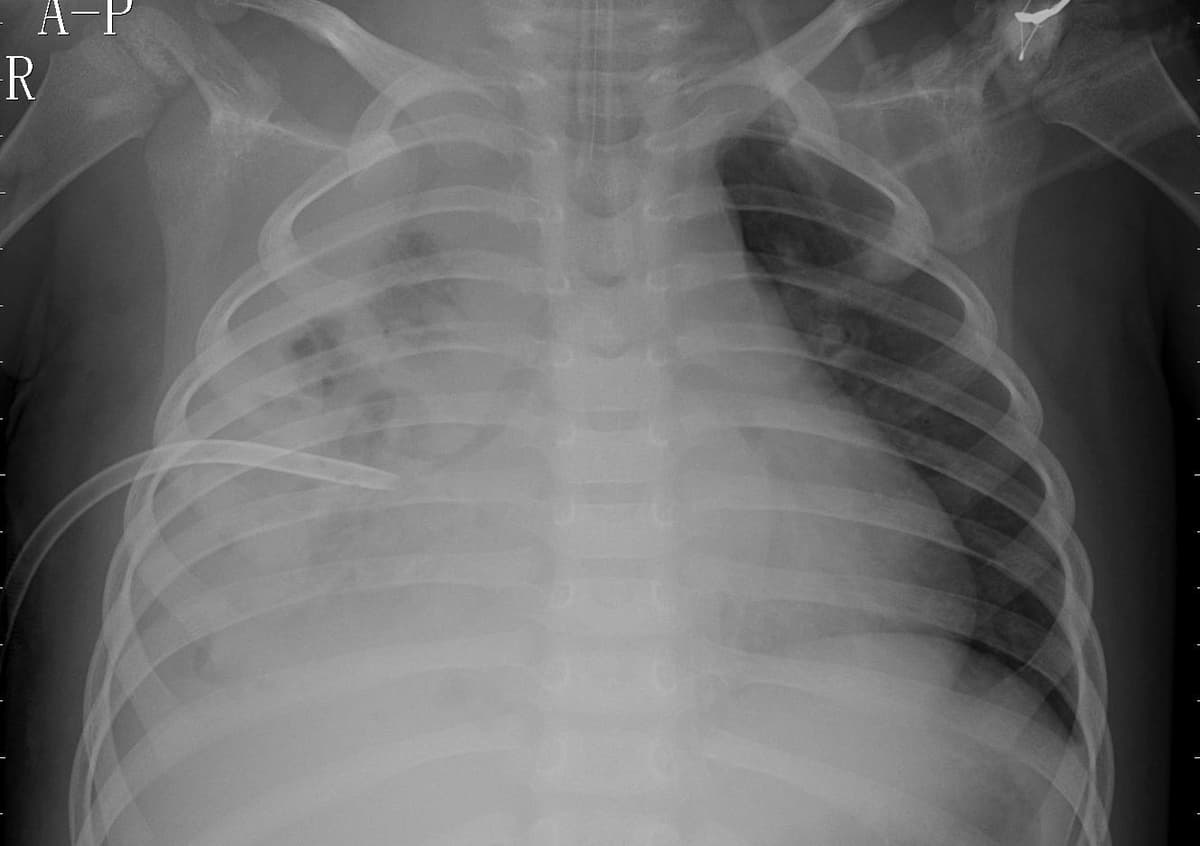 Pneumonia — NIH Chest X-ray14