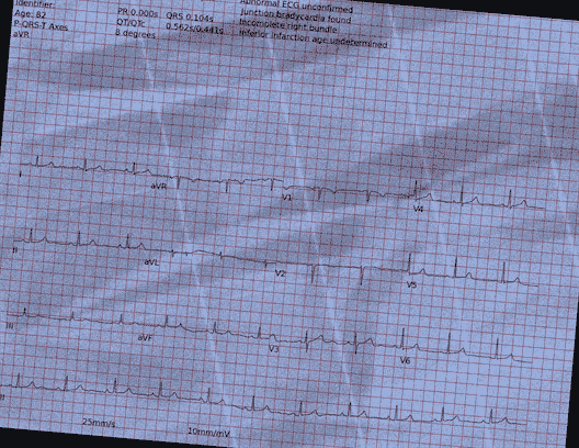Normal ECG — PTB-XL