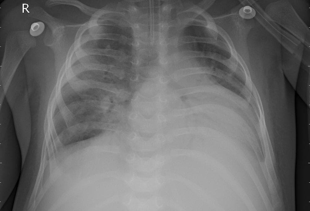 Pneumonia — NIH Chest X-ray14