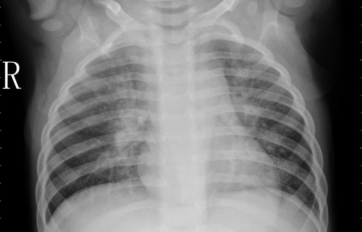 Pneumonia — NIH Chest X-ray14