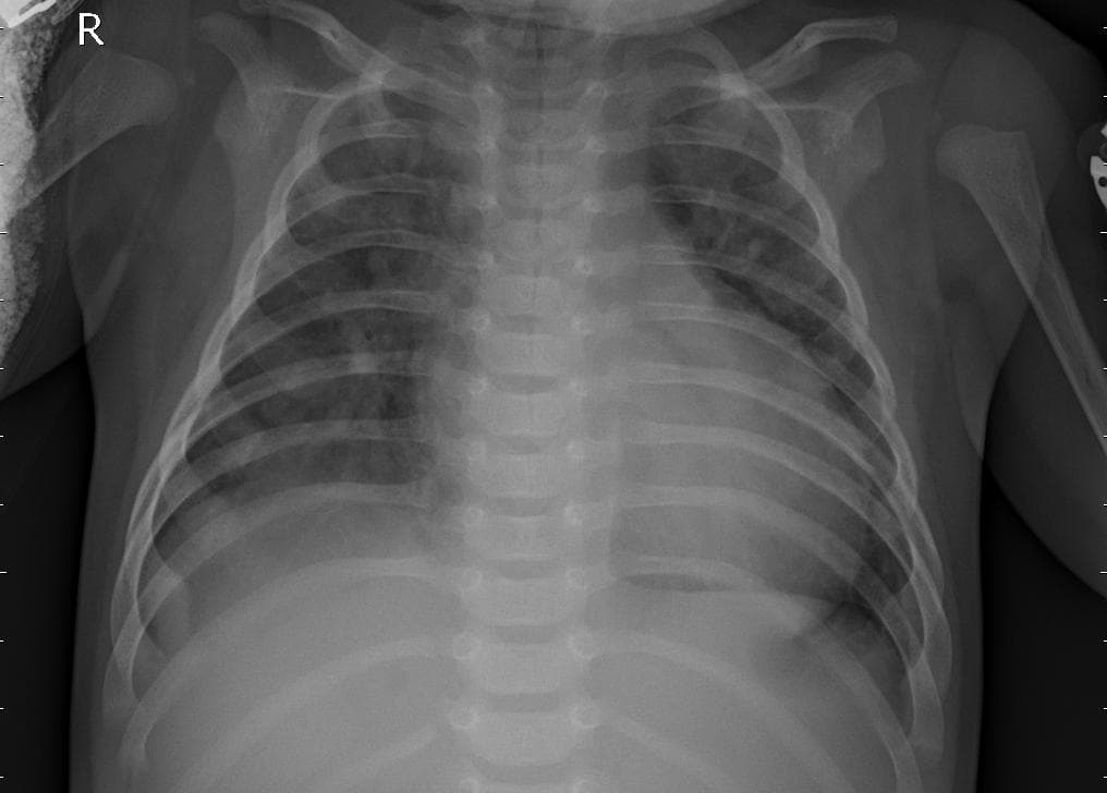 Pneumonia — NIH Chest X-ray14