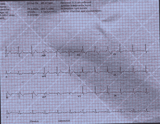 Normal ECG — PTB-XL