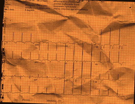 Normal ECG — PTB-XL