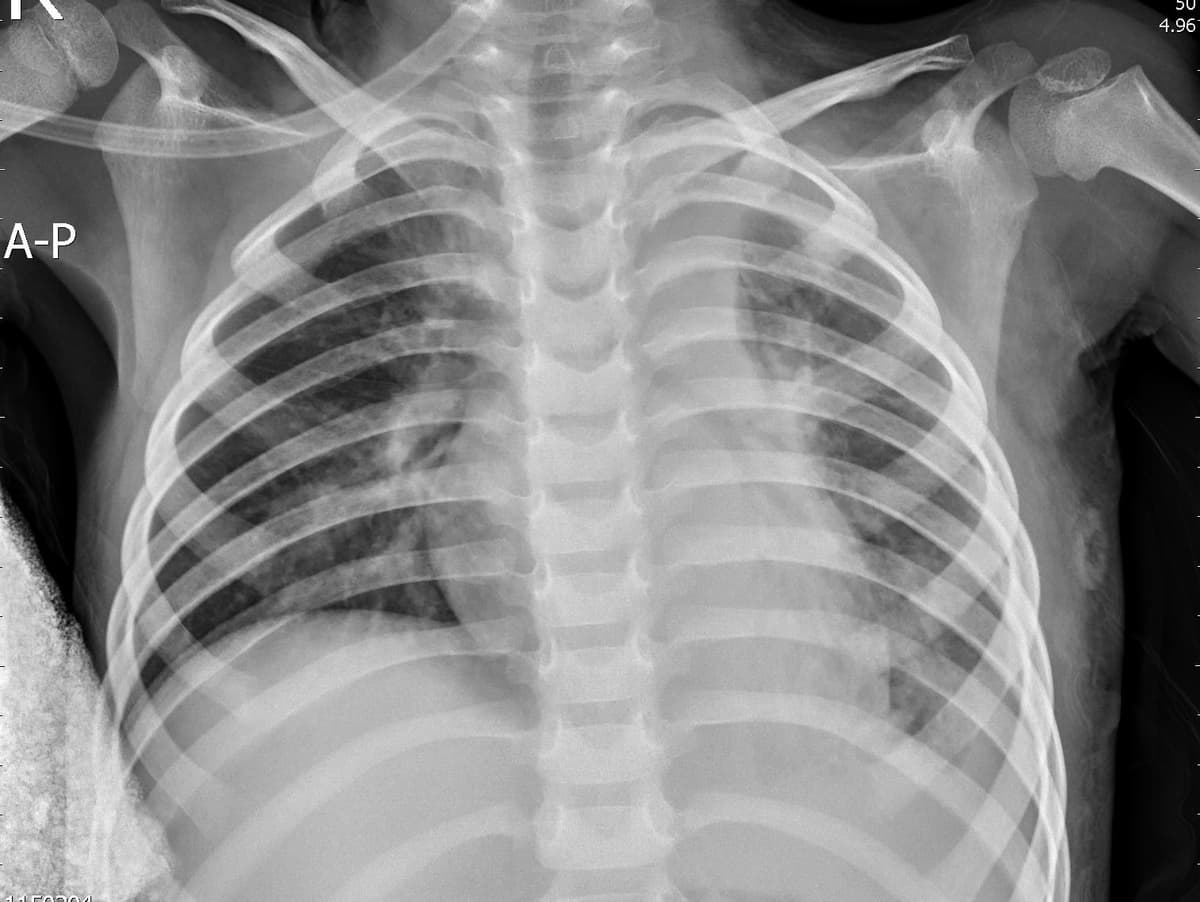 Pneumonia — NIH Chest X-ray14