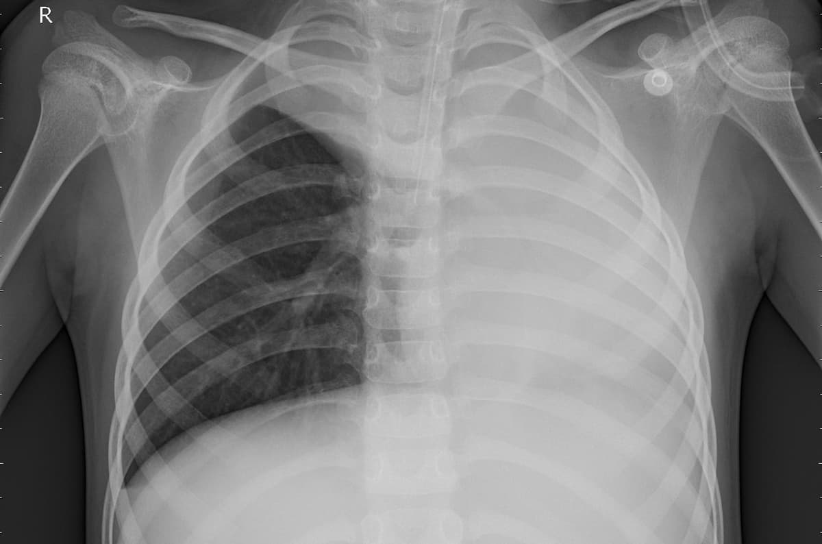 Pneumonia — NIH Chest X-ray14