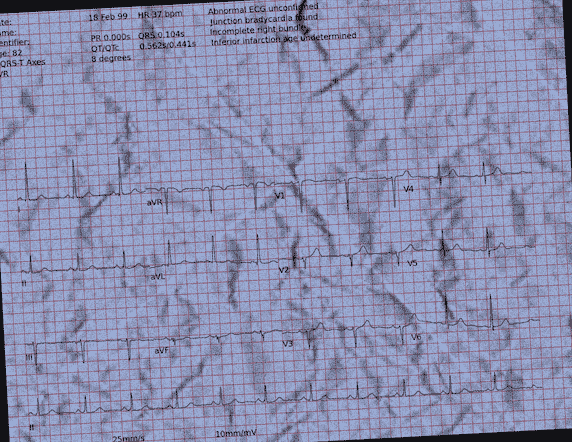 Normal ECG — PTB-XL
