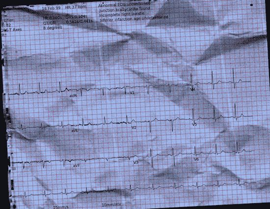 Normal ECG — PTB-XL