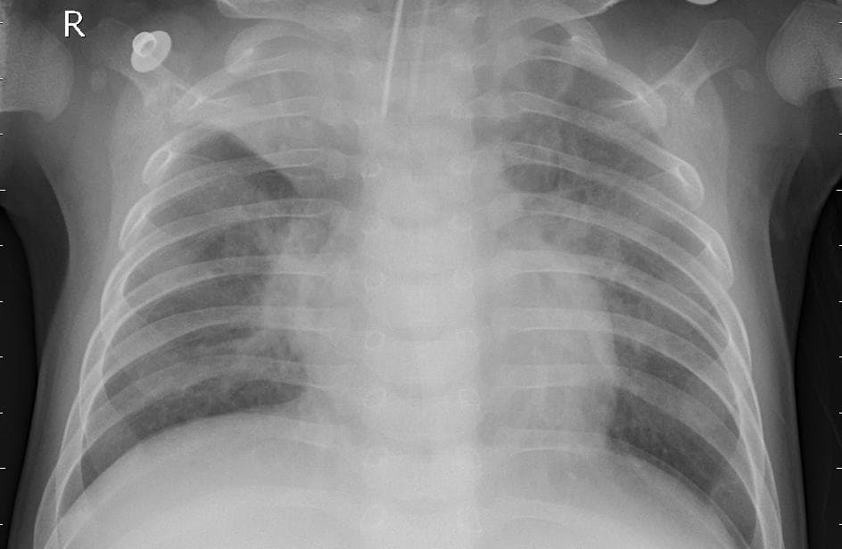 Pneumonia — NIH Chest X-ray14