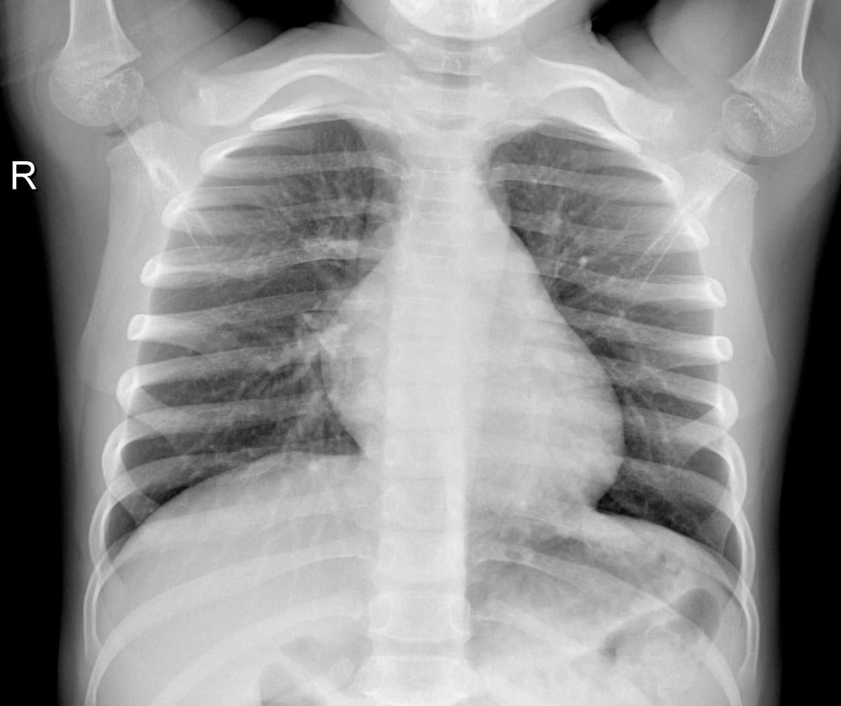 Radiografia Normal — NIH Chest X-ray14
