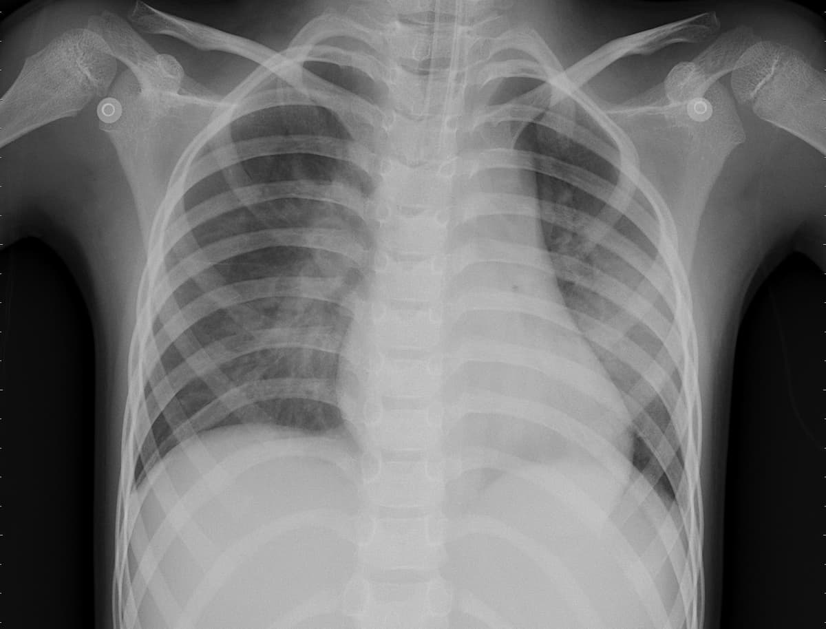 Pneumonia — NIH Chest X-ray14