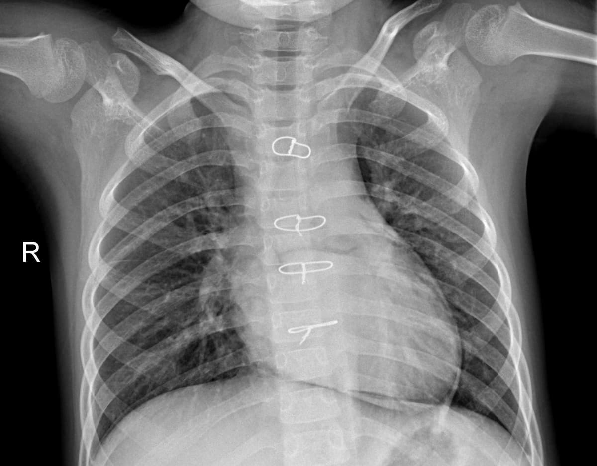 Pneumonia — NIH Chest X-ray14