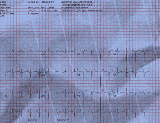 Normal ECG — PTB-XL