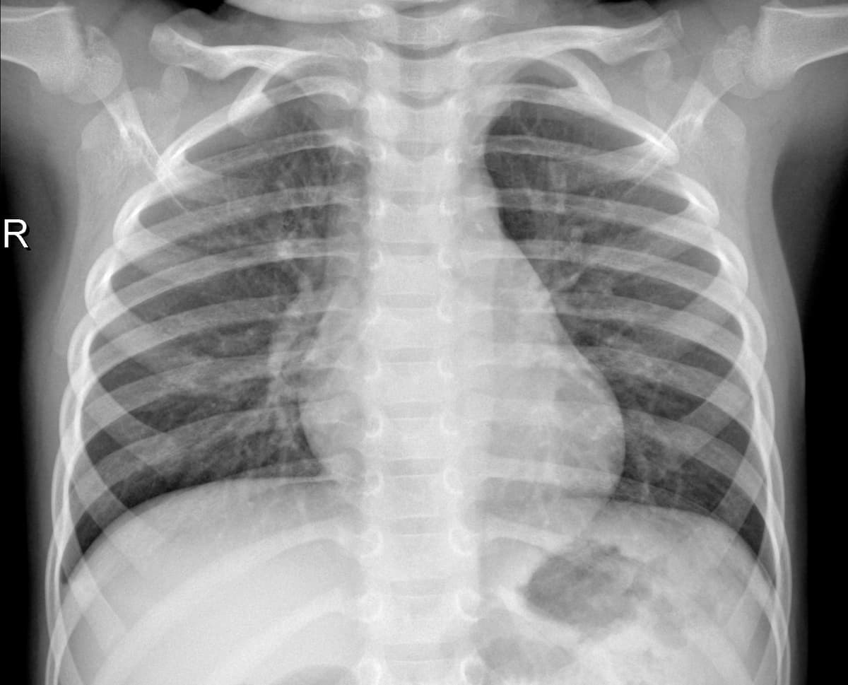 Radiografia Normal — NIH Chest X-ray14
