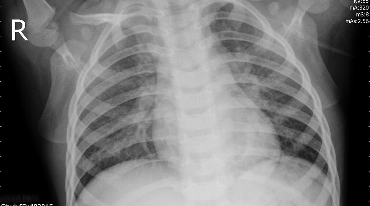 Pneumonia — NIH Chest X-ray14