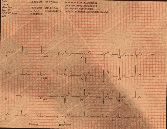 Normal ECG — PTB-XL