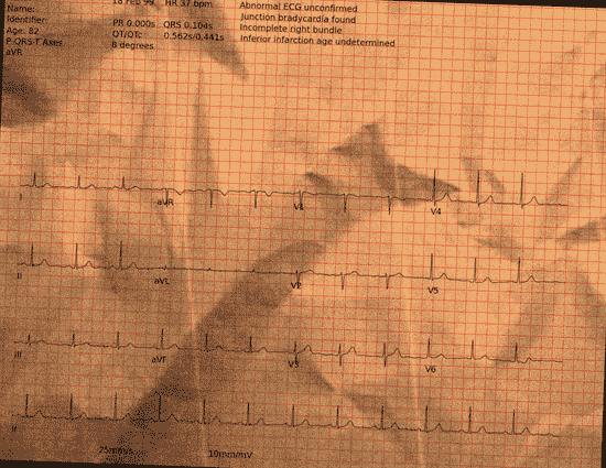 Normal ECG — PTB-XL