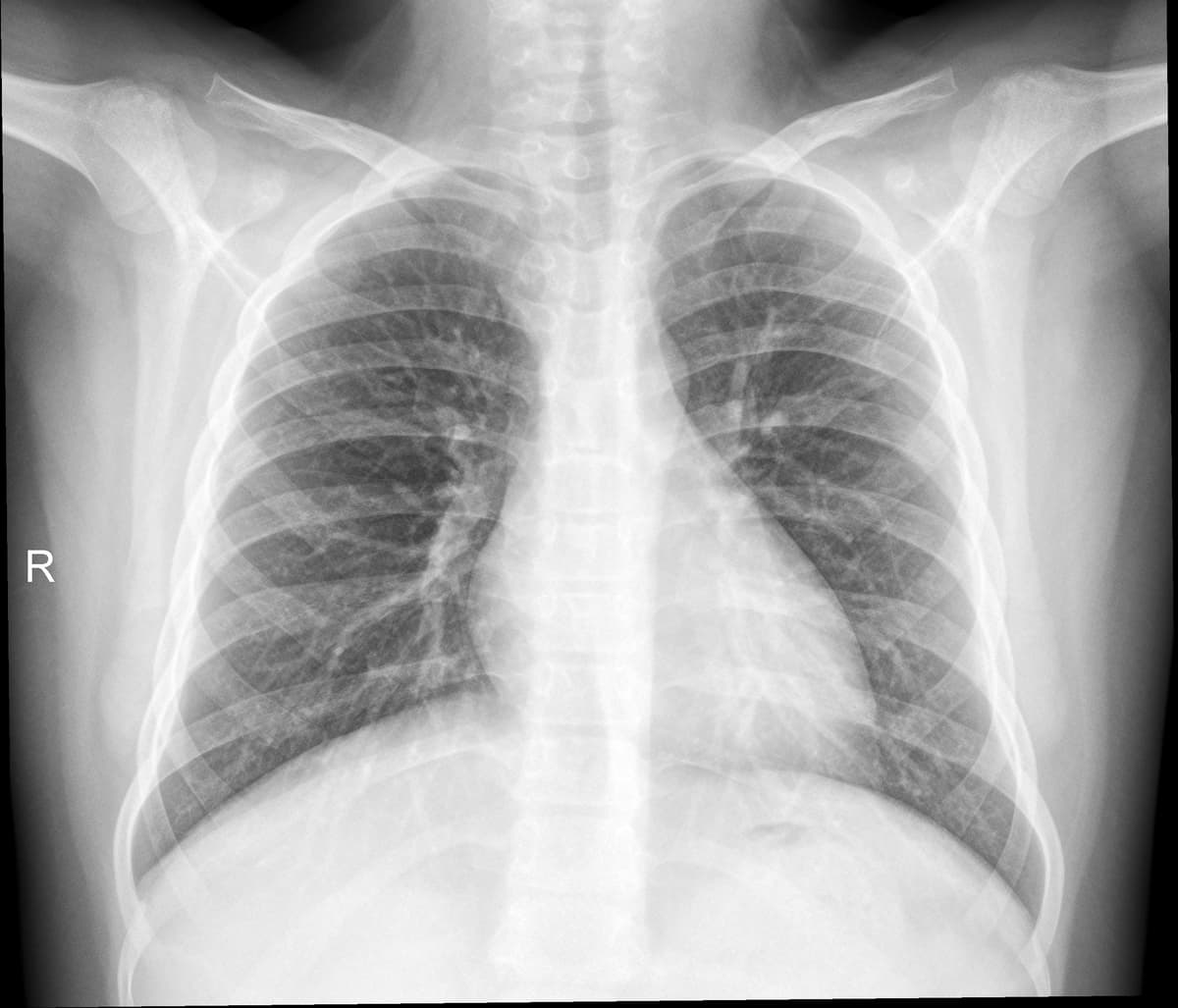 Radiografia Normal — NIH Chest X-ray14