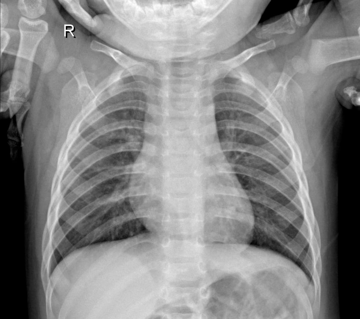 Radiografia Normal — NIH Chest X-ray14