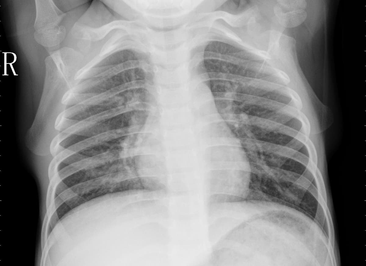 Pneumonia — NIH Chest X-ray14