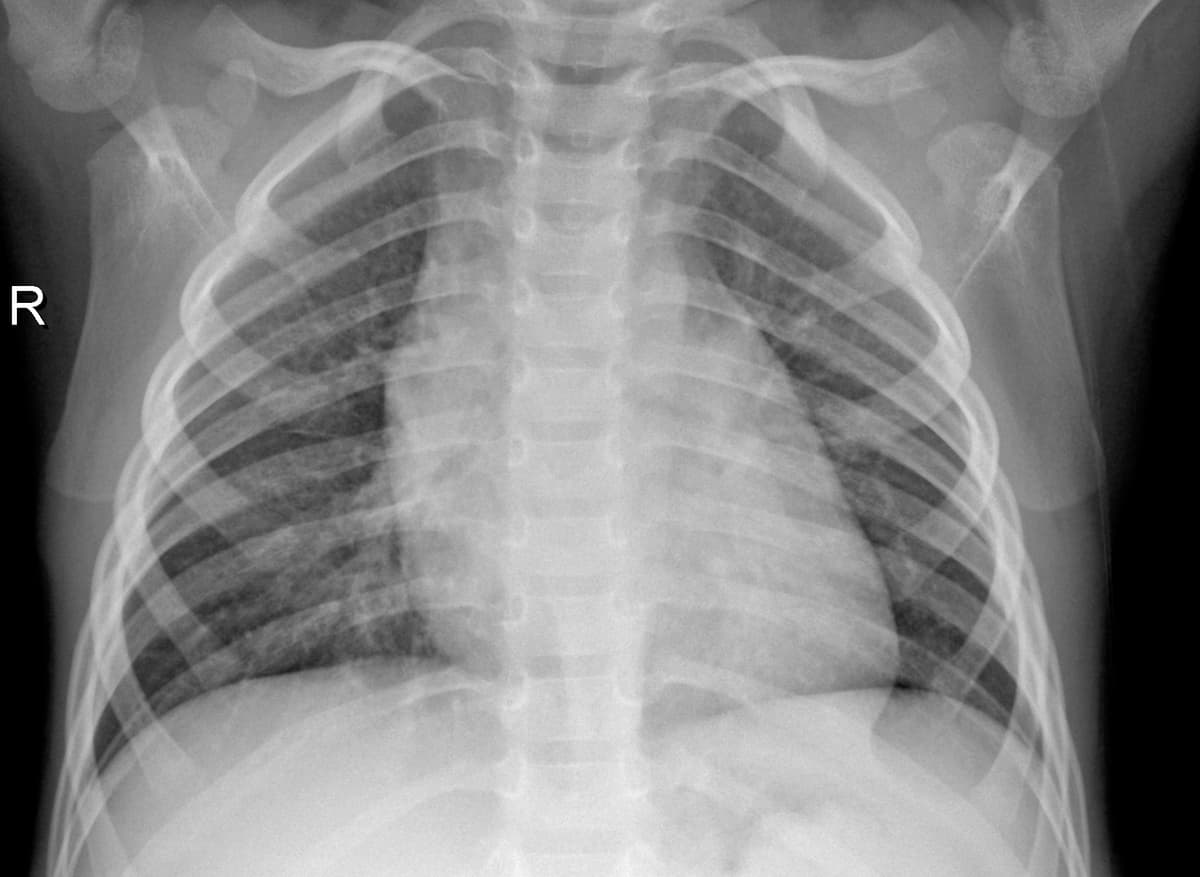 Radiografia Normal — NIH Chest X-ray14