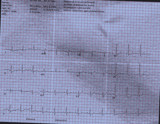 Normal ECG — PTB-XL