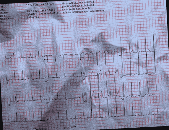 Normal ECG — PTB-XL