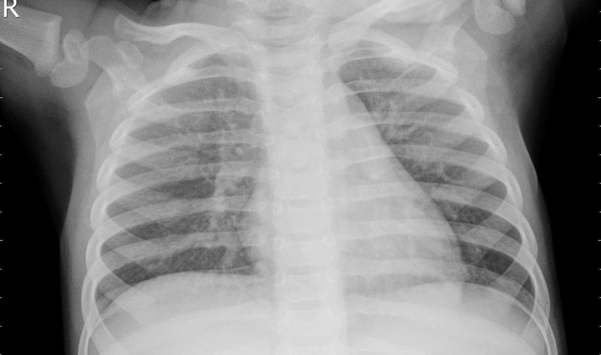 Pneumonia — NIH Chest X-ray14