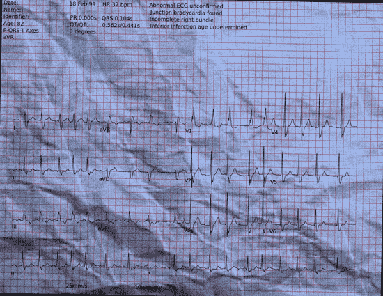 Normal ECG — PTB-XL
