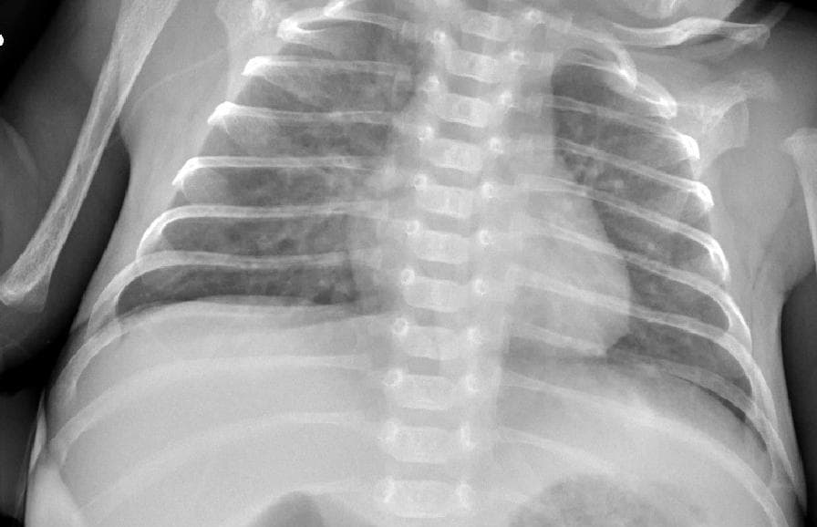 Pneumonia — NIH Chest X-ray14