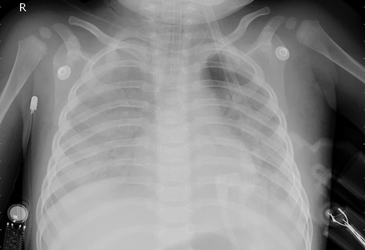 Pneumonia — NIH Chest X-ray14