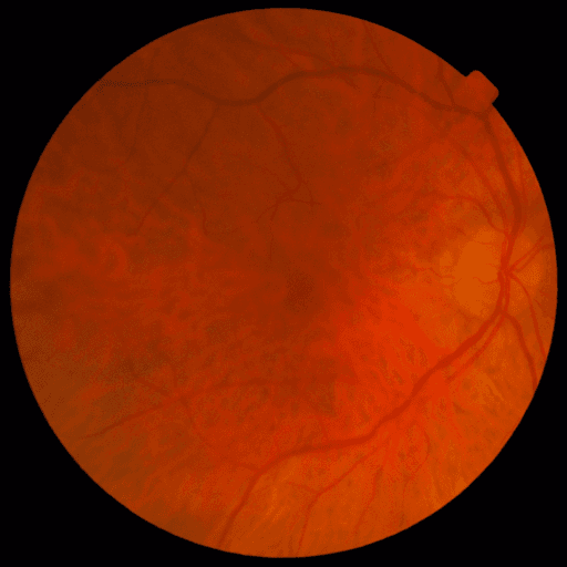 Proliferative DR — MESSIDOR-2