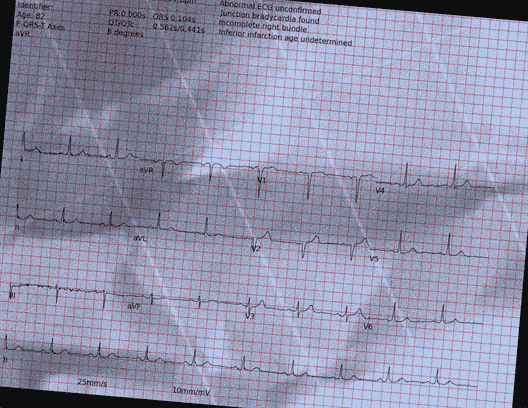 Normal ECG — PTB-XL