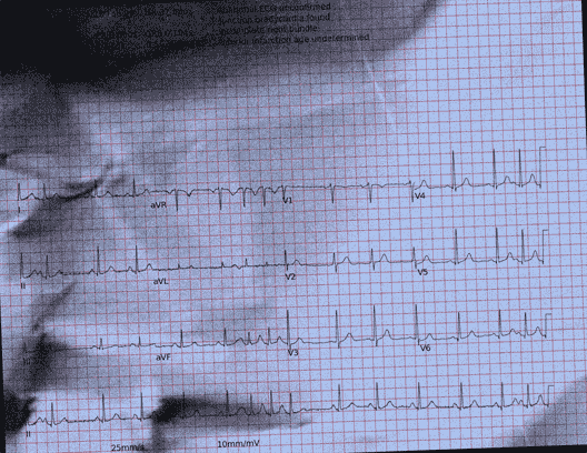 Normal ECG — PTB-XL