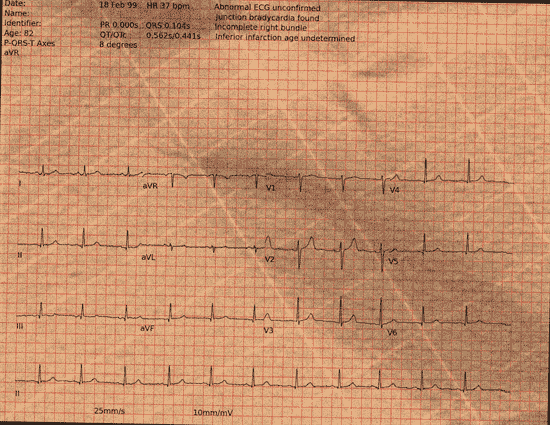 Normal ECG — PTB-XL