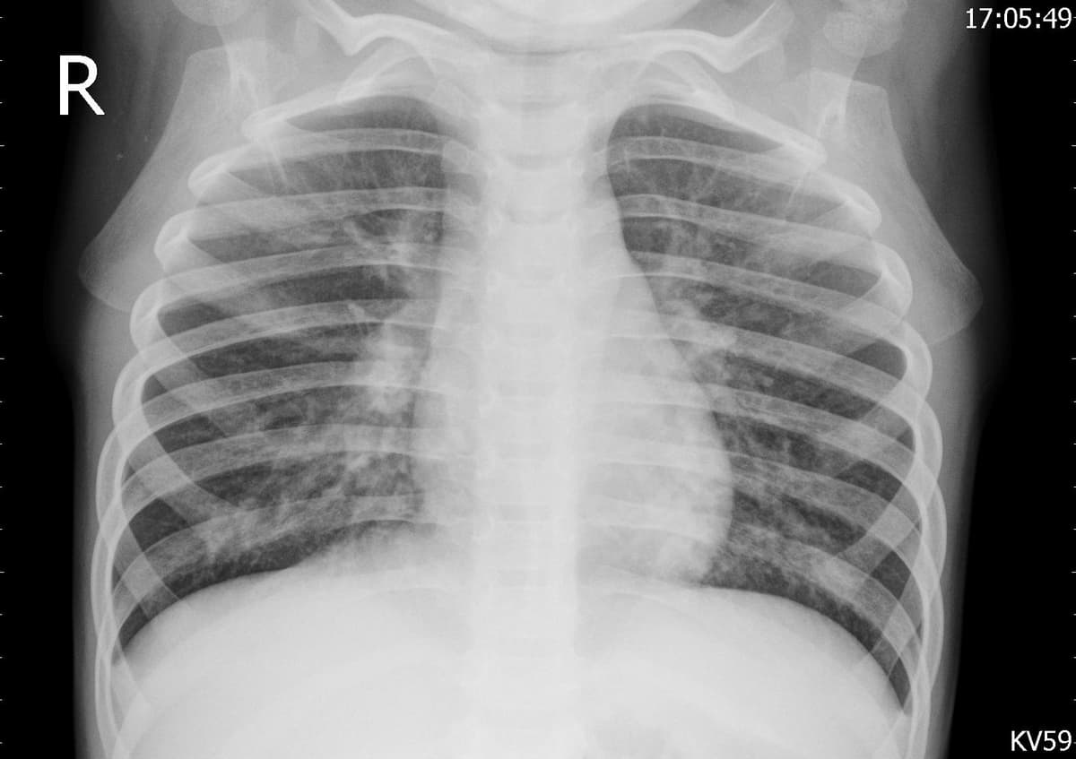 Pneumonia — NIH Chest X-ray14
