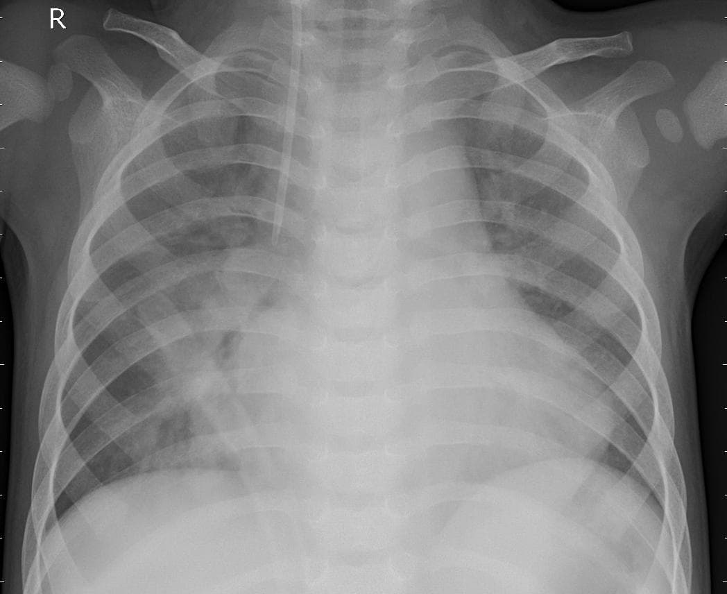Pneumonia — NIH Chest X-ray14