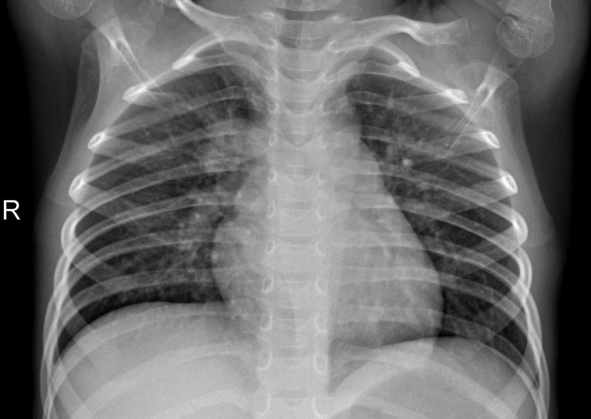 Pneumonia — NIH Chest X-ray14