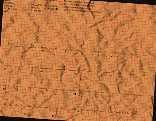 Normal ECG — PTB-XL