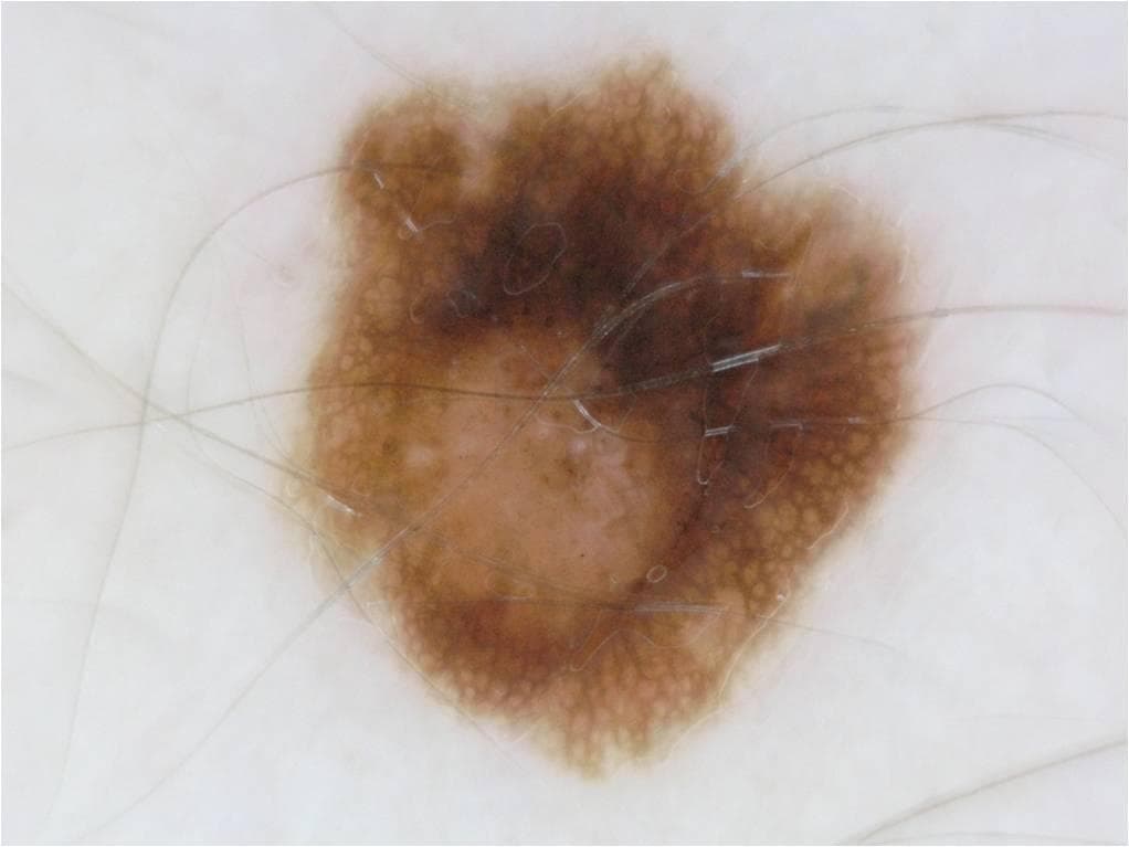 Melanoma — ISIC Archive