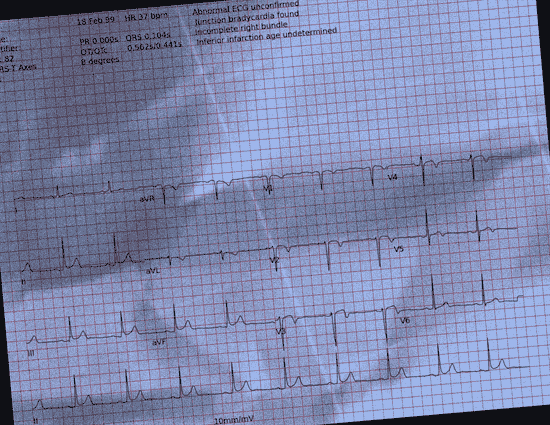 Normal ECG — PTB-XL