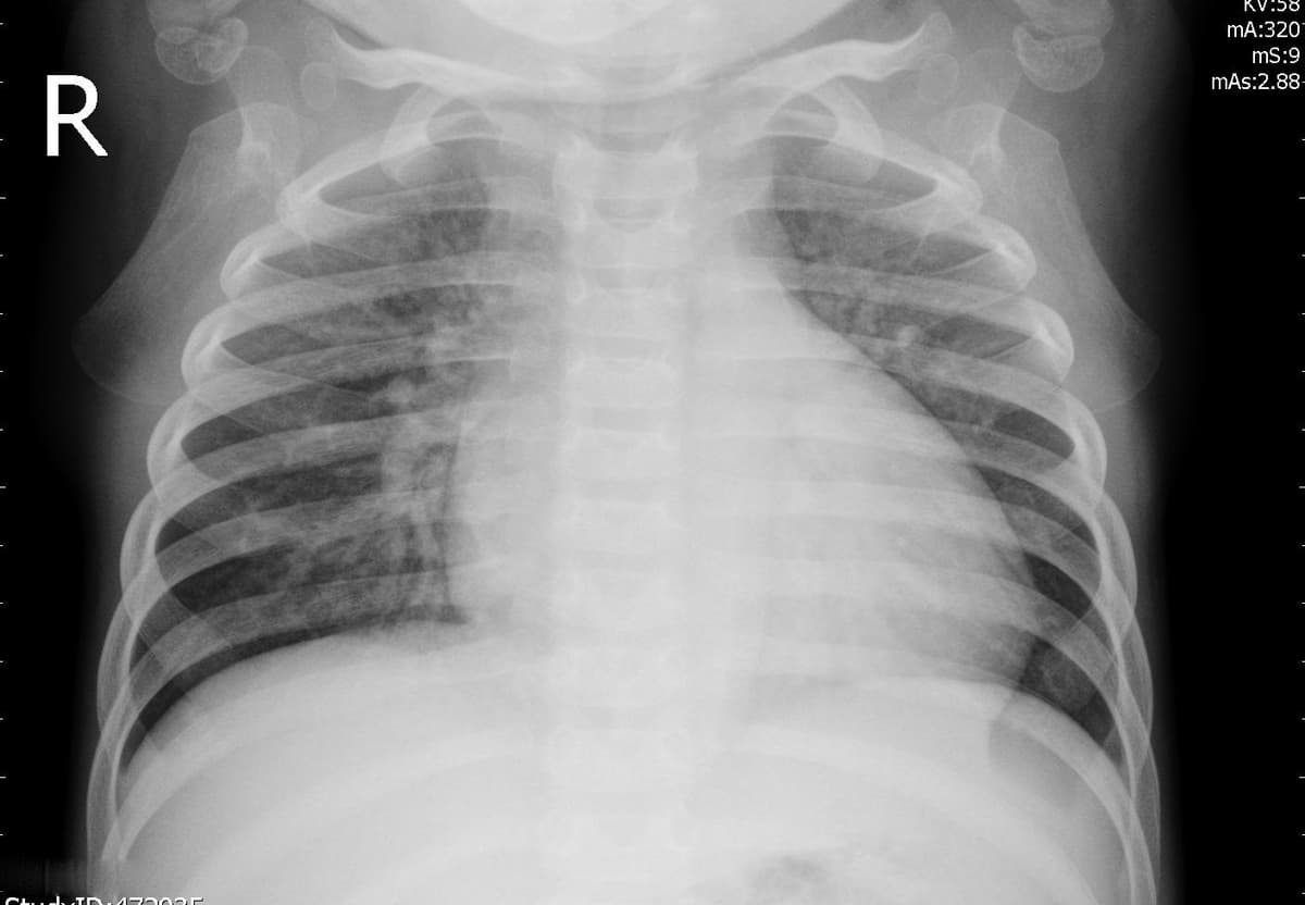 Pneumonia — NIH Chest X-ray14