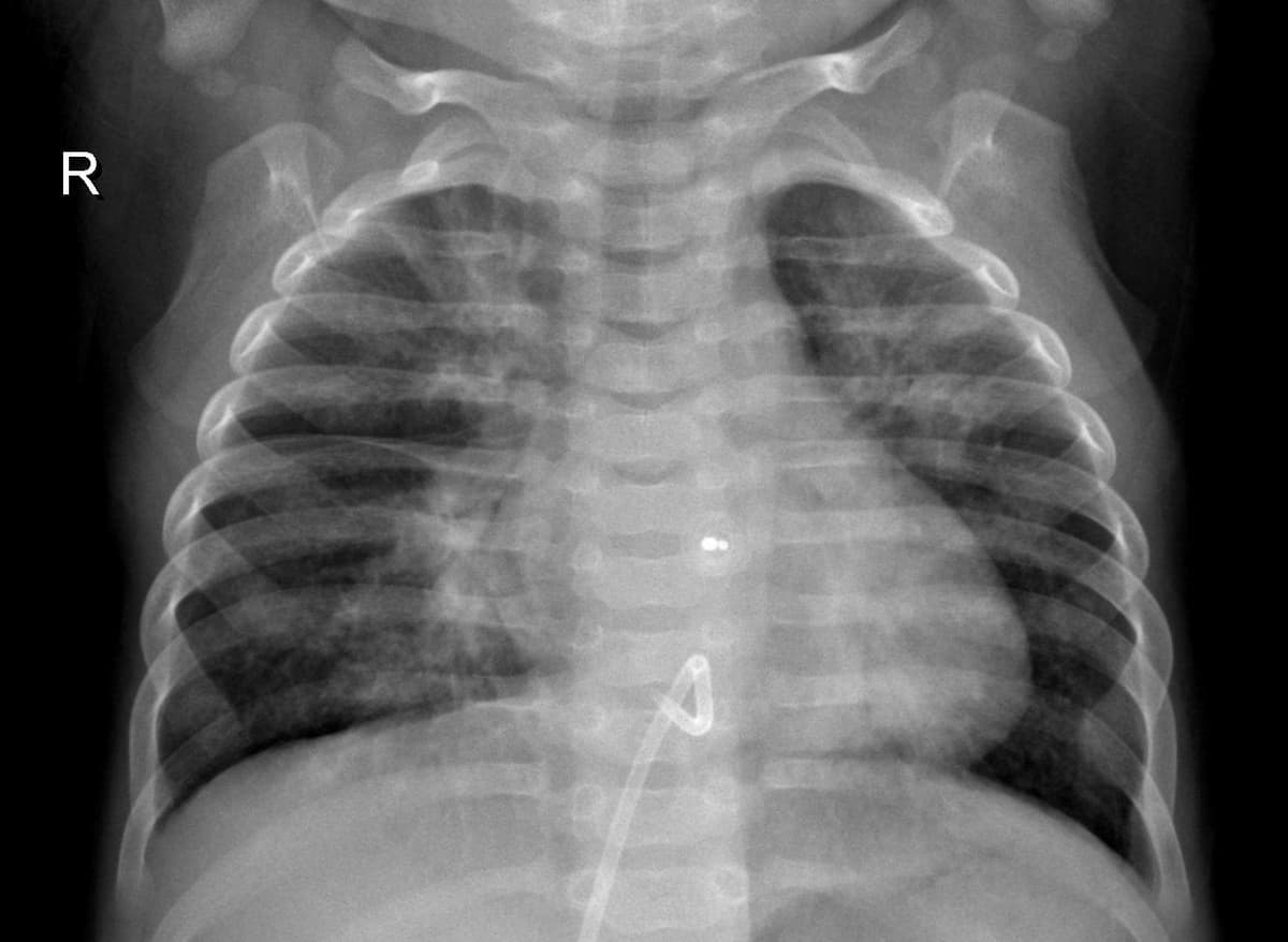 Pneumonia — NIH Chest X-ray14