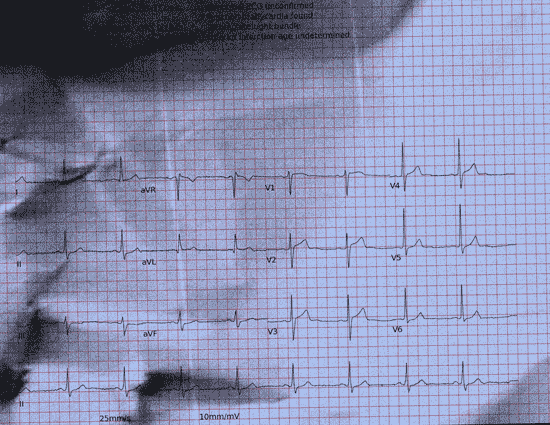 Normal ECG — PTB-XL