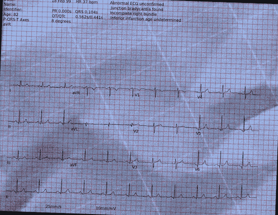 Normal ECG — PTB-XL