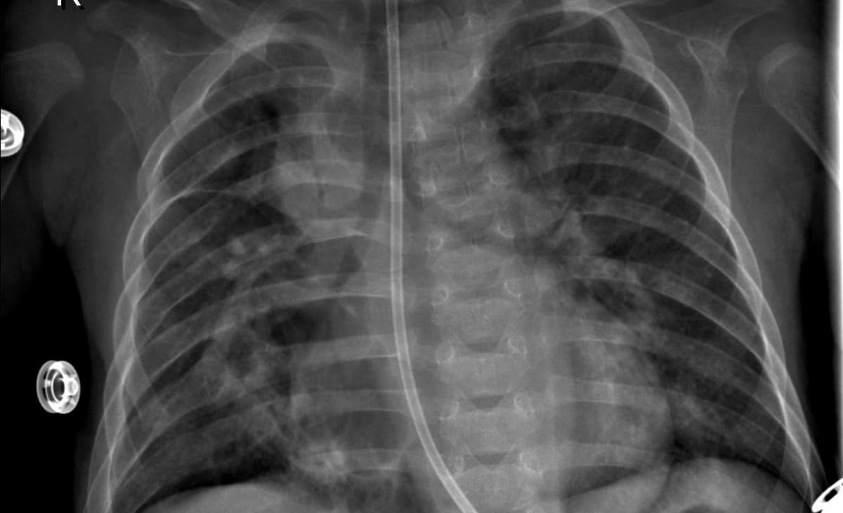 Pneumonia — NIH Chest X-ray14