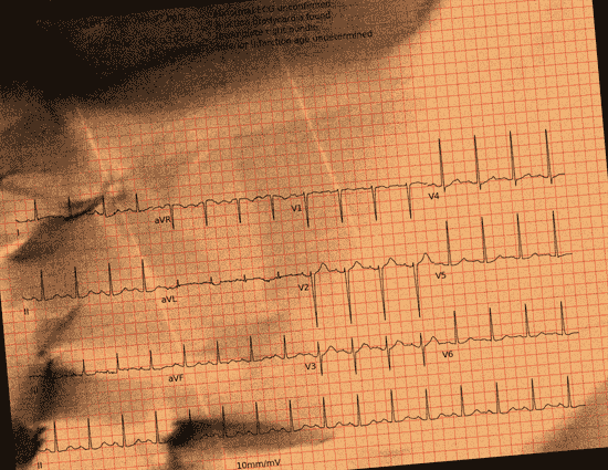 Normal ECG — PTB-XL