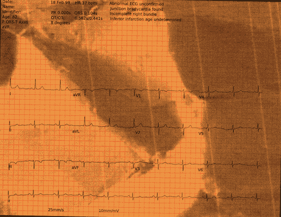 Normal ECG — PTB-XL